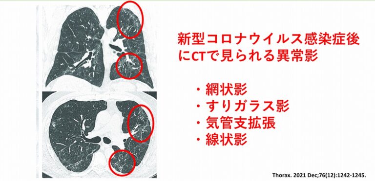 胸部CT検査