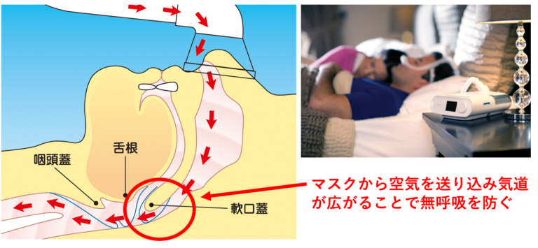 CPAP治療