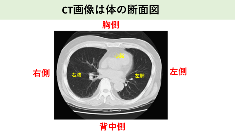 CT画像は体の断面図