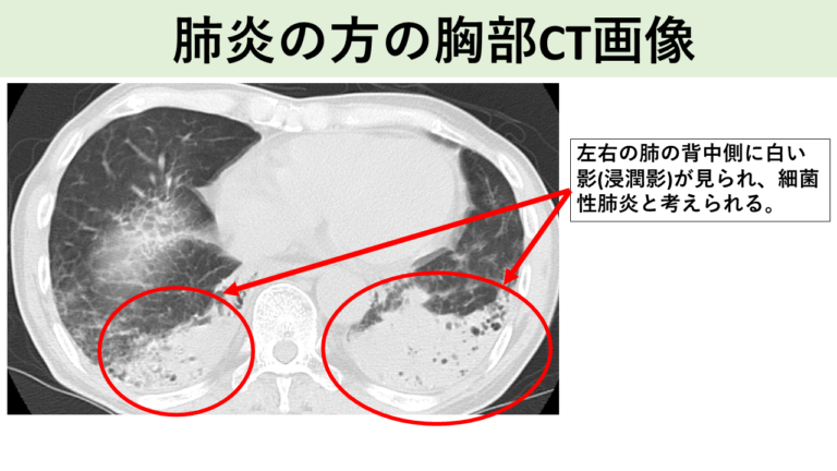 肺炎の方の胸部CT画像