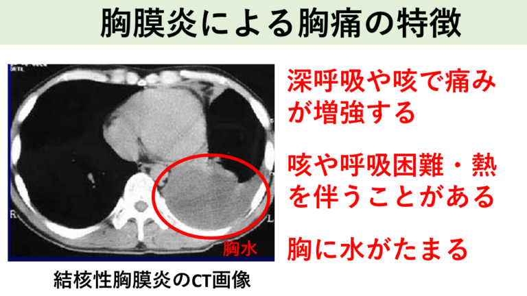 胸膜炎による胸痛の特徴