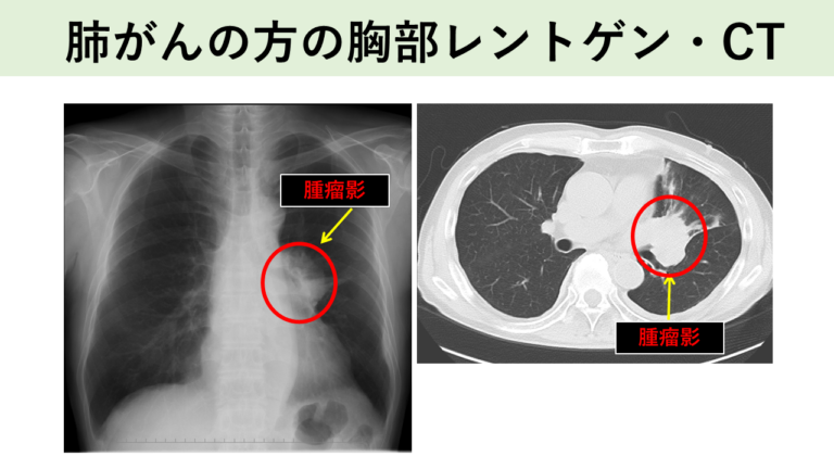 肺がんの方の胸部レントゲン・CT
