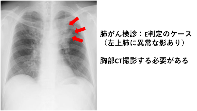 胸部レントゲン異常とは