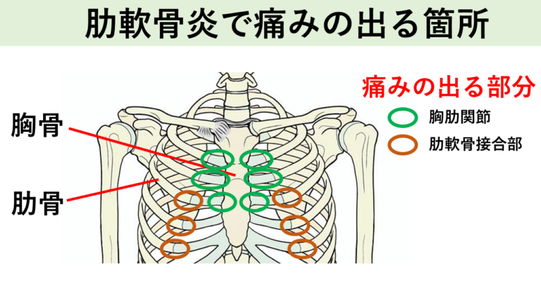 肋軟骨炎で痛みの出る箇所