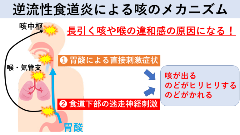 逆流性食道炎による咳のメカニズム