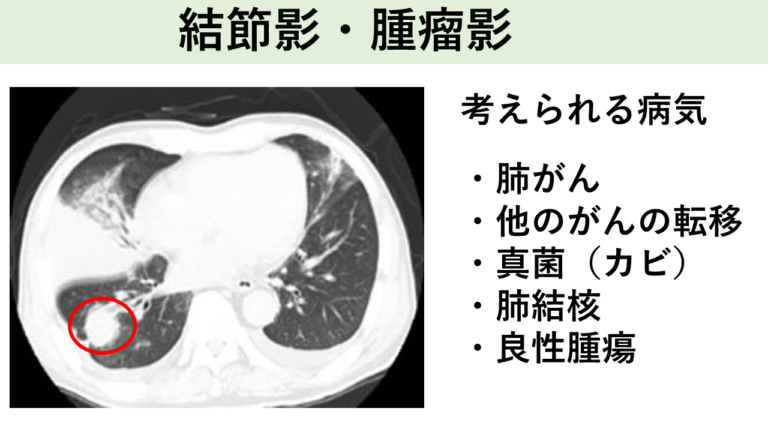 結節影・腫瘤影