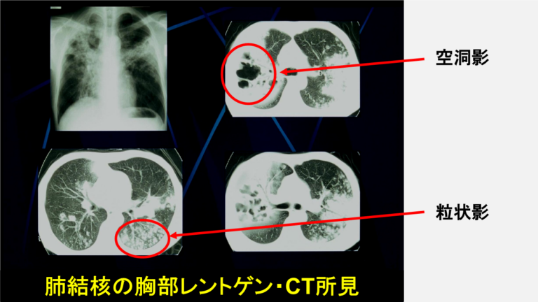 肺結核の胸部レントゲン
