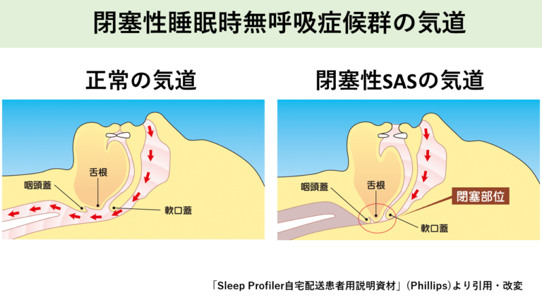 閉塞性睡眠時無呼吸症候群の気道