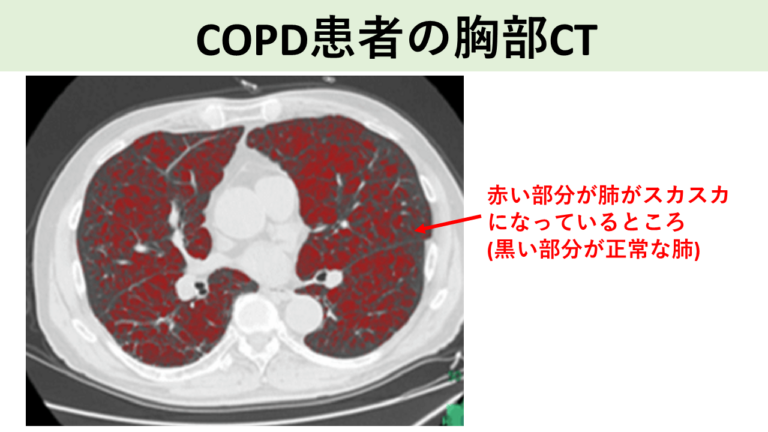 COPD患者の胸部CT