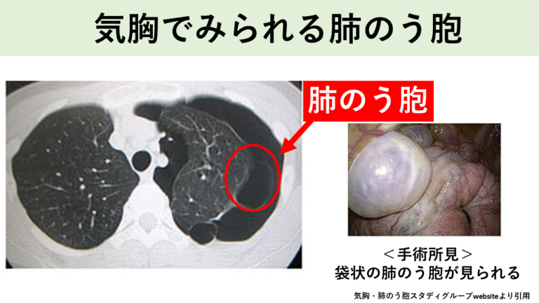 気胸でみられる肺のう胞