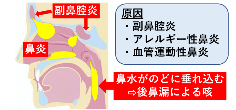 上気道咳嗽(がいそう)症候群