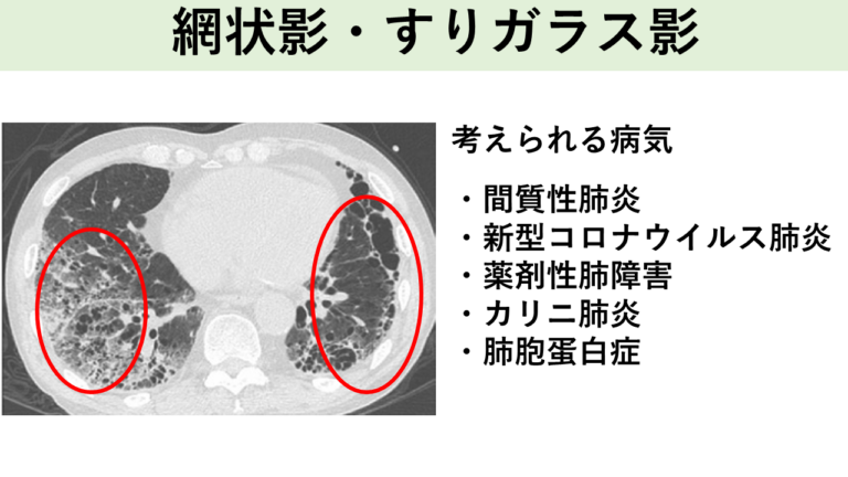 網状影・すりガラス影