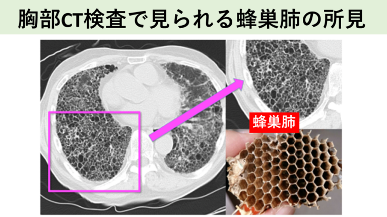 胸部CT検査で見られる蜂巣肺の所見