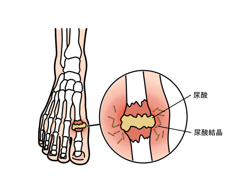 高尿酸血症ってどんな病気？