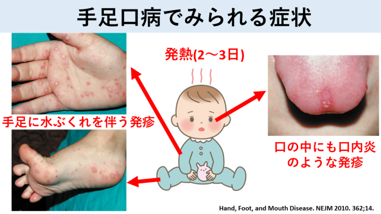 手足口病でみられる症状