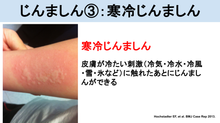 じんましんとは？