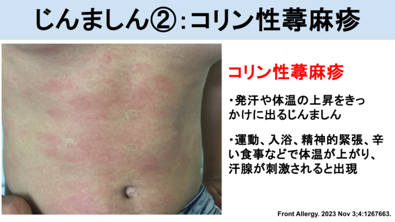 じんましんとは？