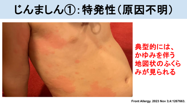 じんましんとは？