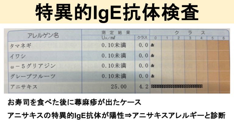 じんましんの検査